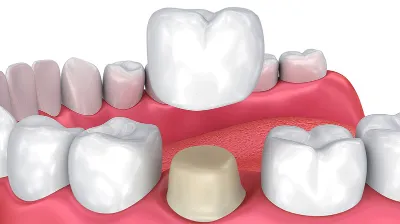 Dental crown