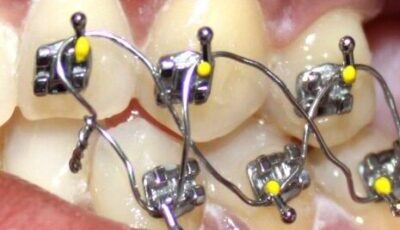 Weight loss jaw wiring