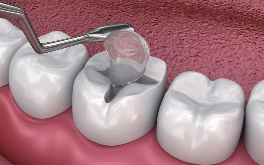 white filling process