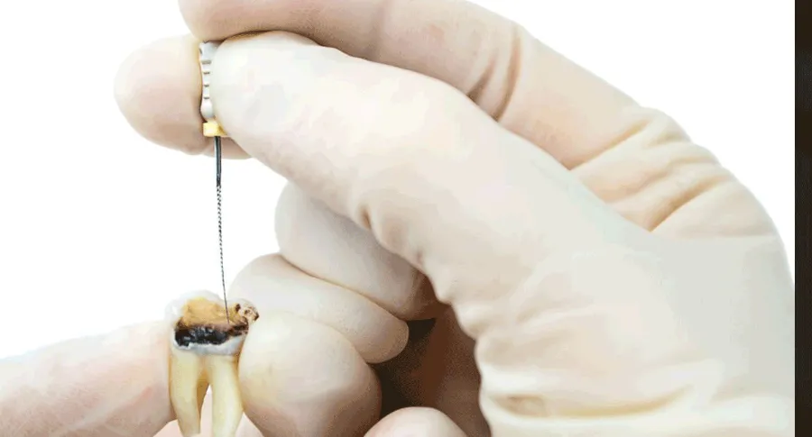 Root Canal Example