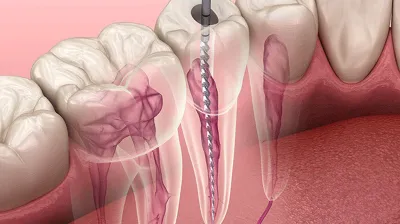 root canal process