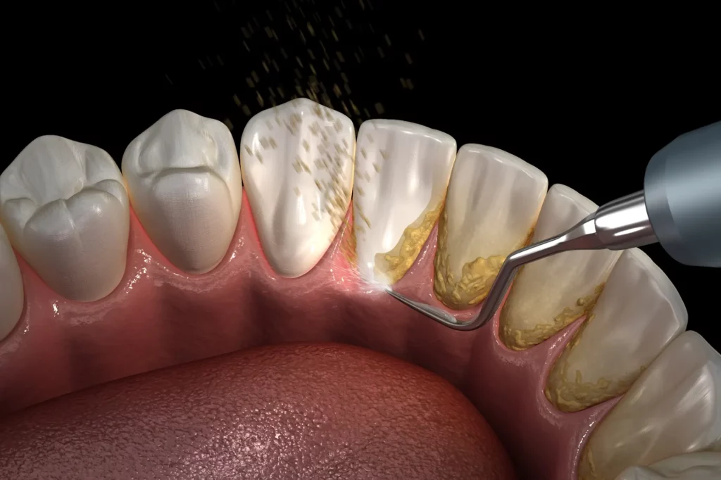 teeth cleaning process