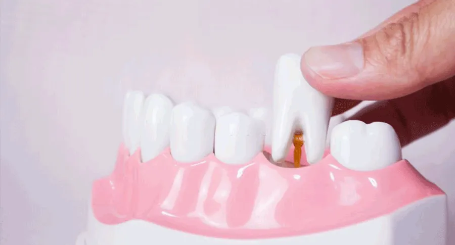 Tooth removal concept