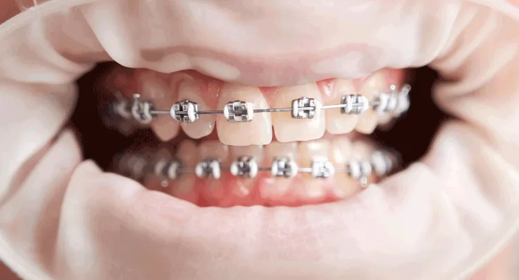 braces frontal view