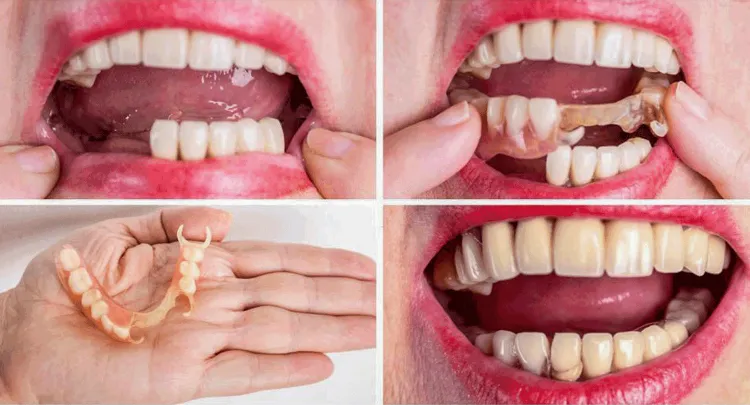 Dentures before and after