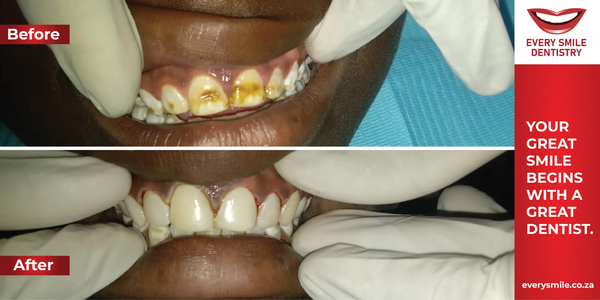 smile makeover teeth closeup