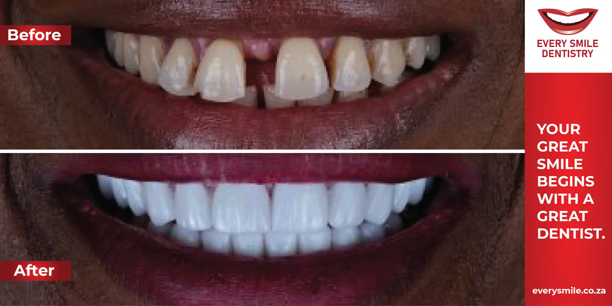 closing grap before and after transformation