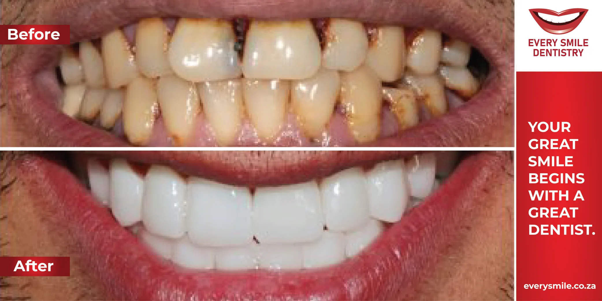 rotten teeth transformation before and after