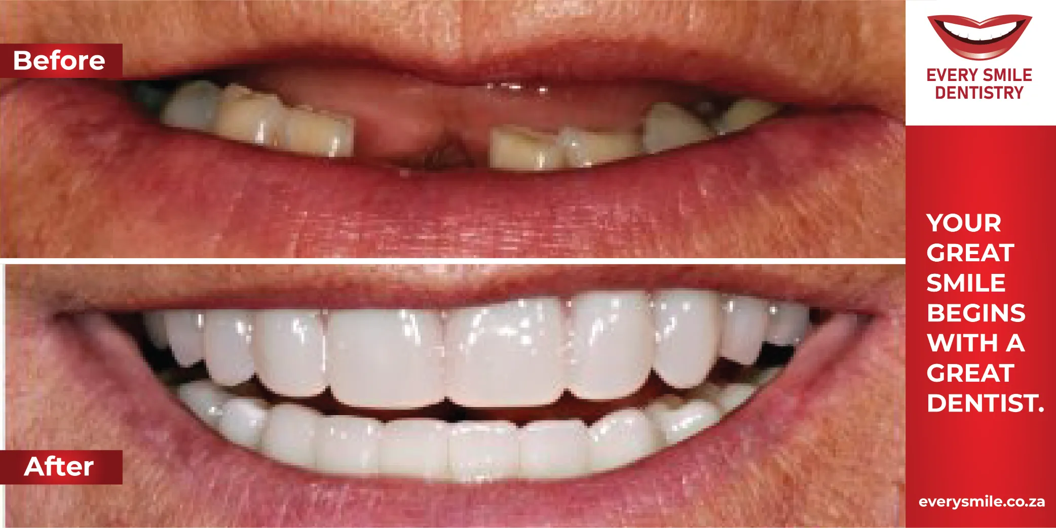 missing teeth transformation before and after