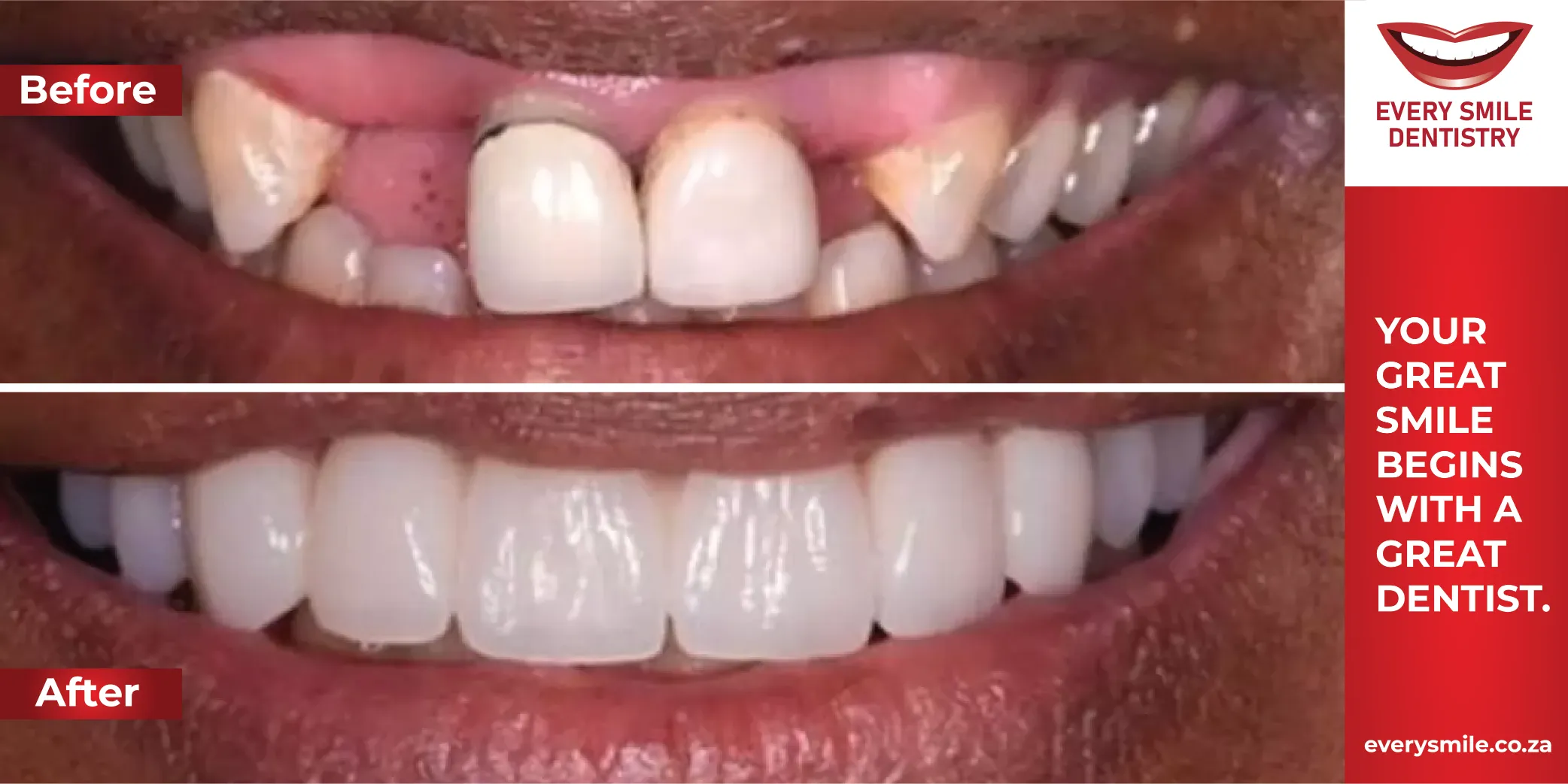 missing tooth transformation before and after