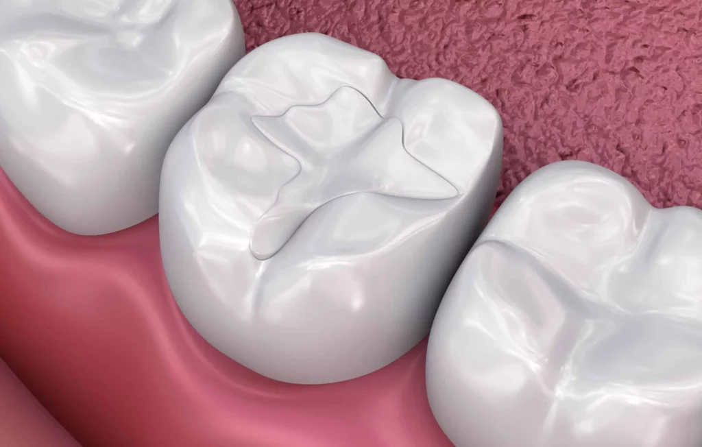 white teeth filling sample