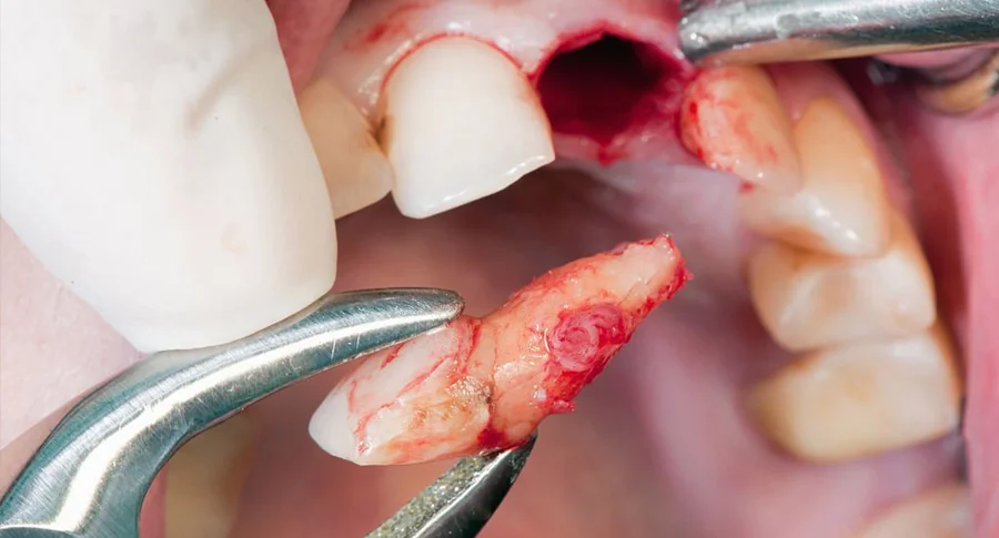closeup teeth removal