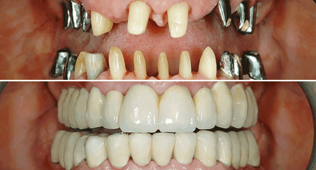 Before and After dental implants